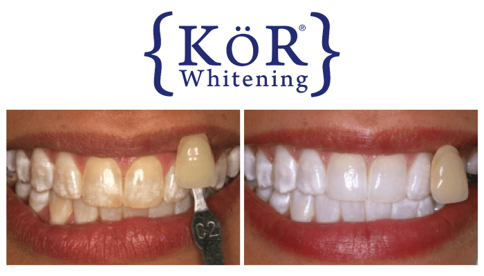 Teeth Whitening | KOR | Georgetown SC Dentist | Pawleys Island Dental