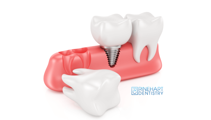 Dental implants Georgetown SC dentists