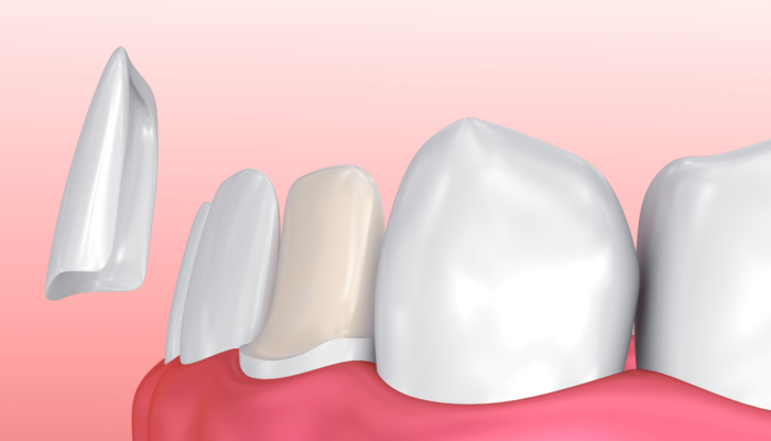 RD_Services_Veneers1