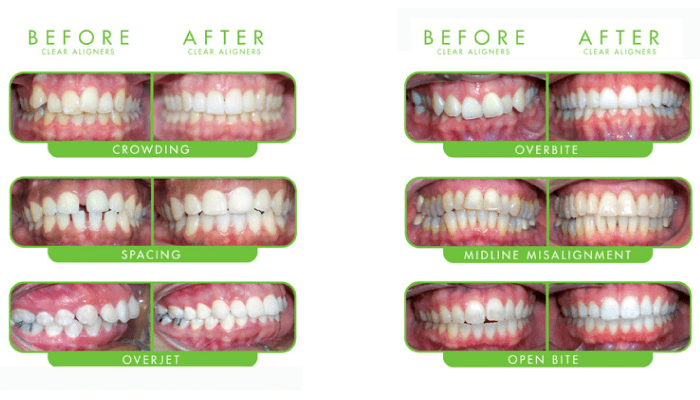 clear braces cost