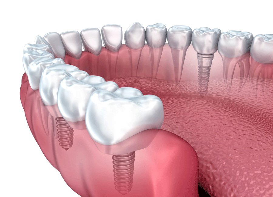 dental_implants_pawleys_Island_south_carolina